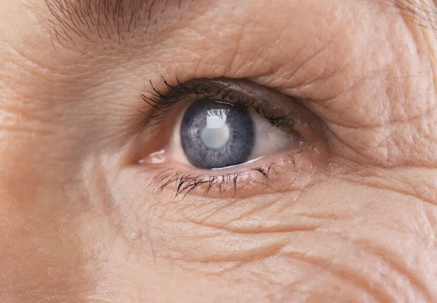 Grauer Star Trübe Augenlinse Sichtbar getrübte Augenlinse. Messbar ist die Trübung sowie die Sehfähigkeit meist lange bevor sie von außen so deutlich sichtbar ist wie auf diesem Bild.